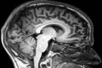 Disorders of consciousness Cross section of a brain in a skull